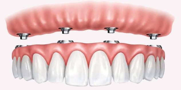 All-on-Four implant — Çapa Ortodonti