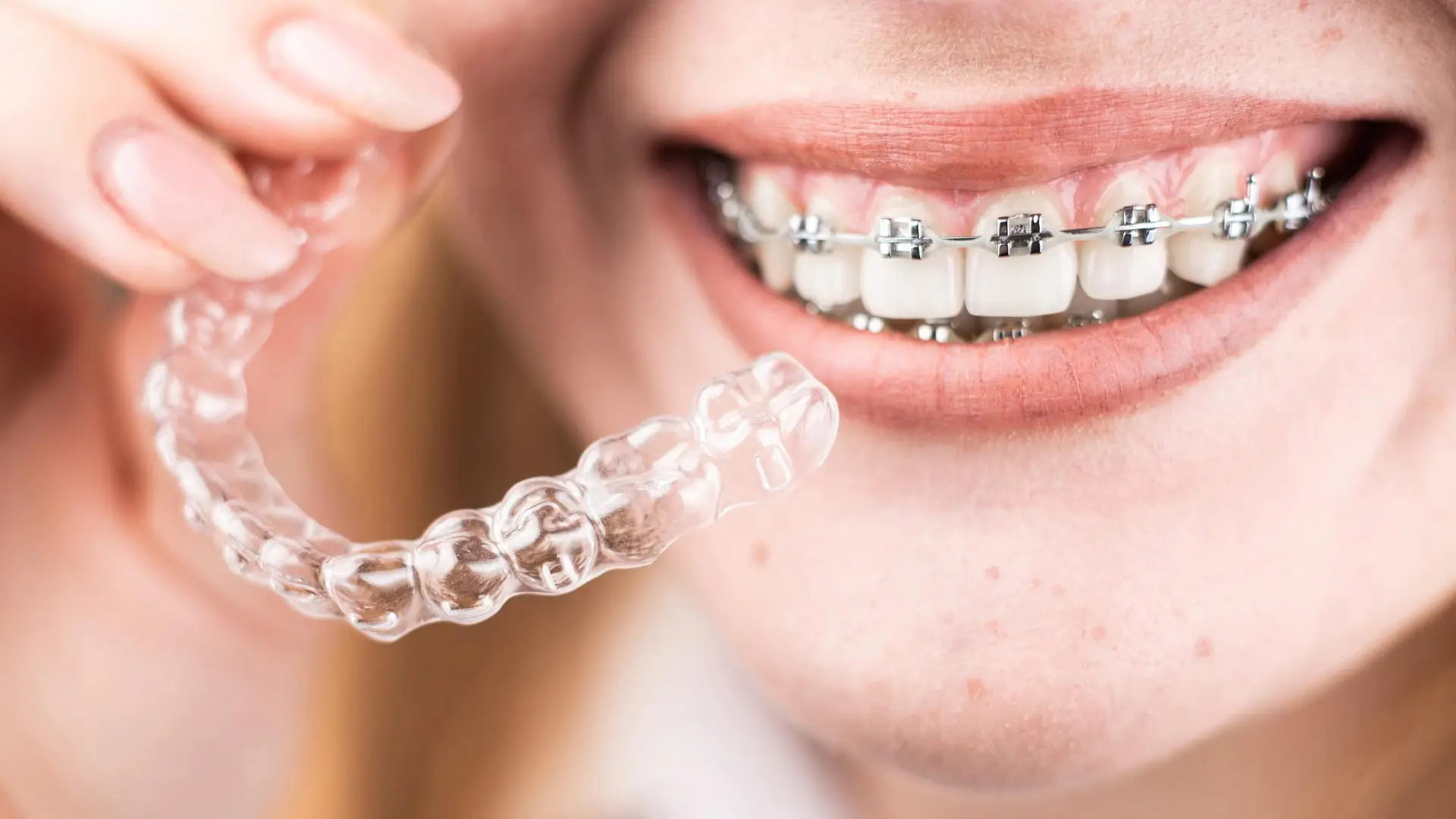 Ortodontik braket ve şeffaf plak modeli